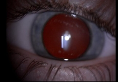 Bild på ett öga med normal röd reflex. En ljus strimma syns som är ljuset från mikroskopet som speglas. 