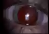 Bild på ett öga med normal röd reflex. En ljus strimma syns som är ljuset från mikroskopet som speglas.