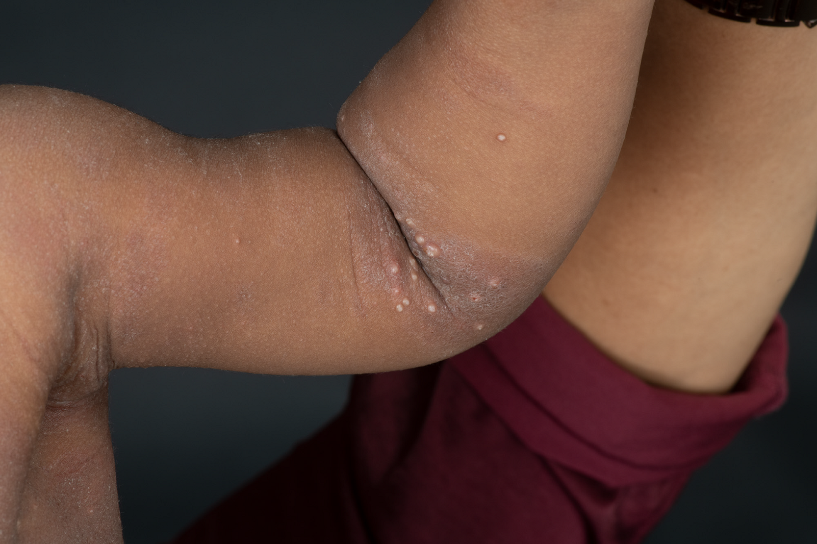 Bild på ett barns arm med mollusker.