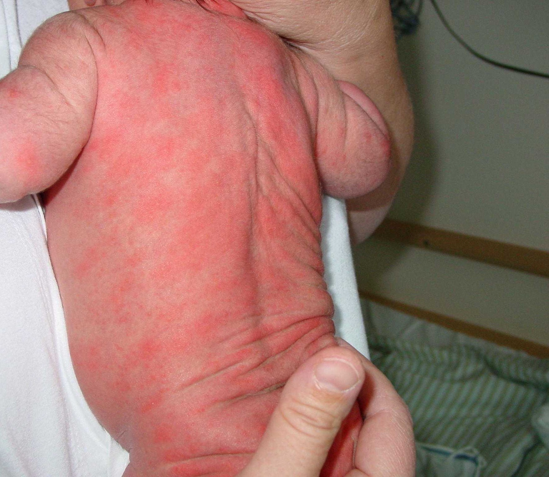 Ett naket spädbarn ligger med magen mot bröstet på en vuxen person. Barnets rygg är täckt av röda utslag.