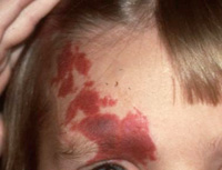Kärlmissbildning Nevus flammeus på ansikte på barn. Bild. 