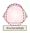 Illustration av brachycephaly.