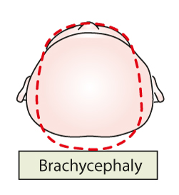 Illustration av brachycephaly.