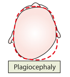Barn som har en sned skallform, plagiocephaly. Illustration.