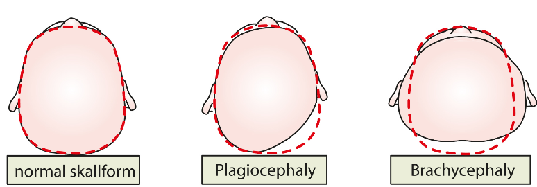 tre barnskallar sedda bakifrån liggandes på rygg, den ena visar en normal skallform och de två övriga visar plagiocephaly och brachycephaly