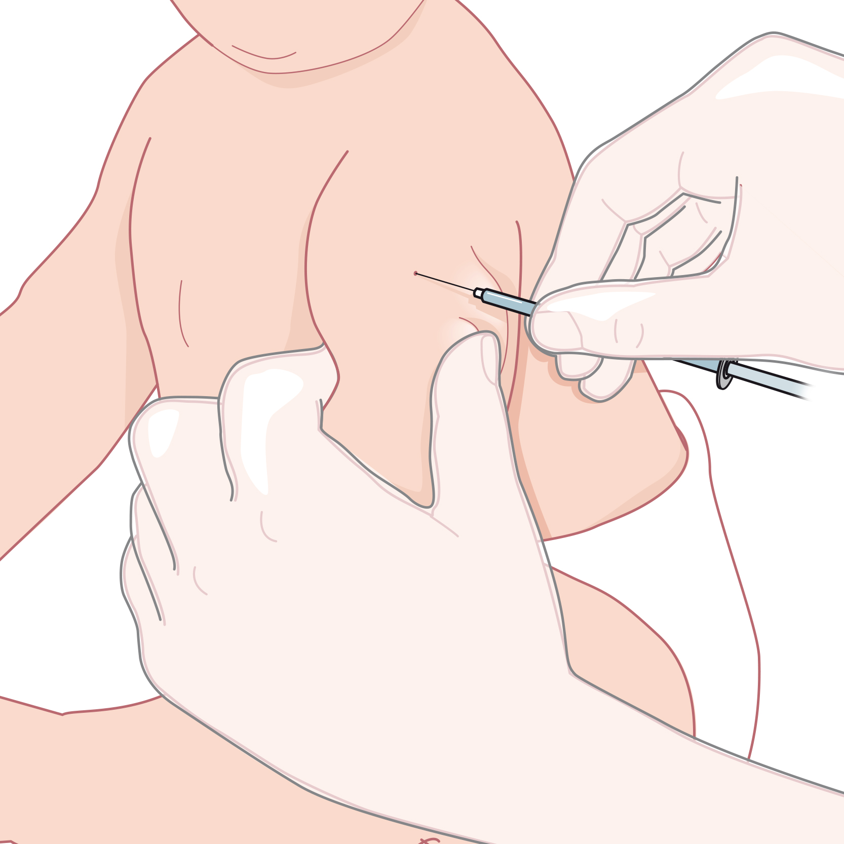 Två vuxna händer håller i ett barns arm och sätter en intrakutan injektion med sprutan i 10 graders vinkel