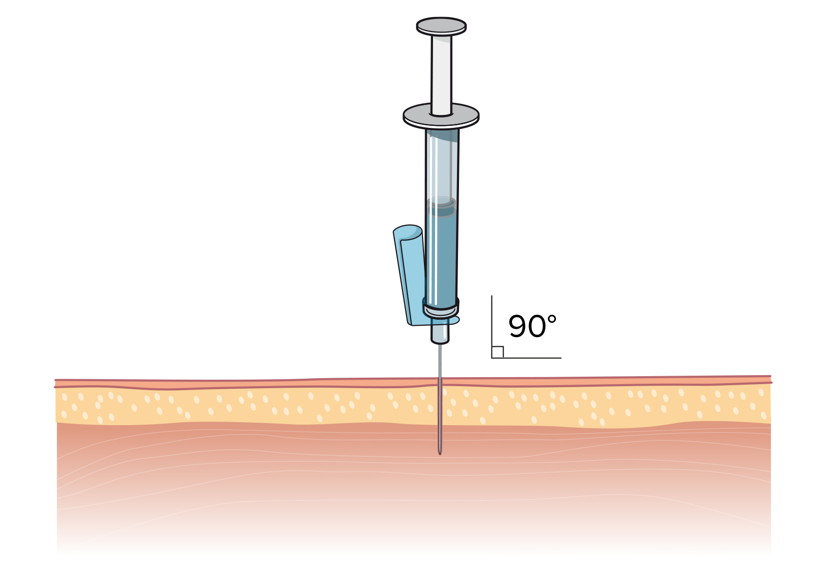 En nål som sticks ner i hudlagren och in i muskelvävnaden i 90 graders vinkel.