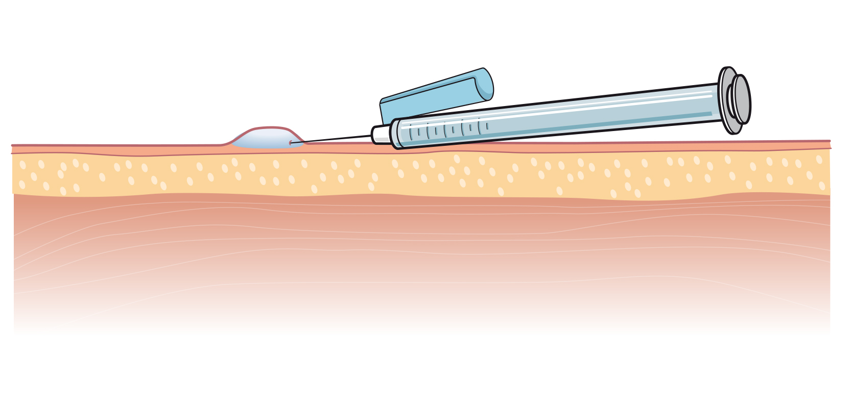 Hudlagren i genomskärning. Sprutan går in i huden i tio graders stickvinkel och i yttersta hudlagret ser man en kvaddel.